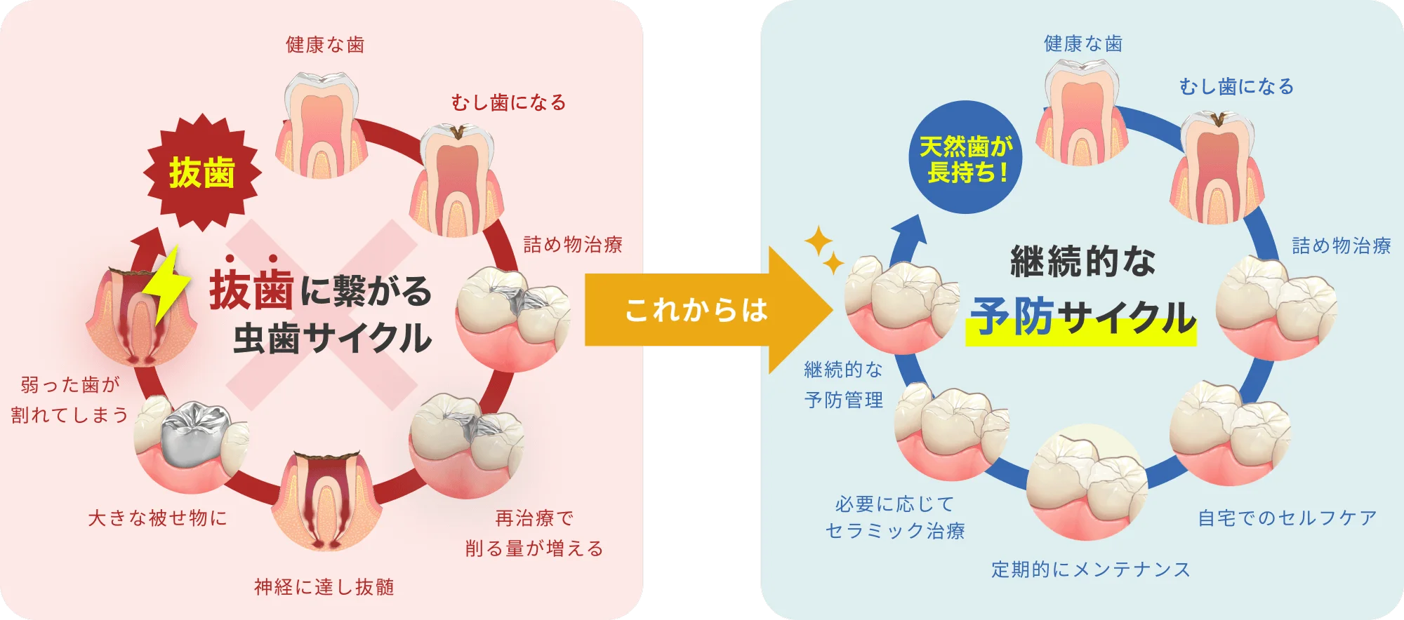 抜歯に繋がるむし歯サイクル これからは 継続的な予防サイクル